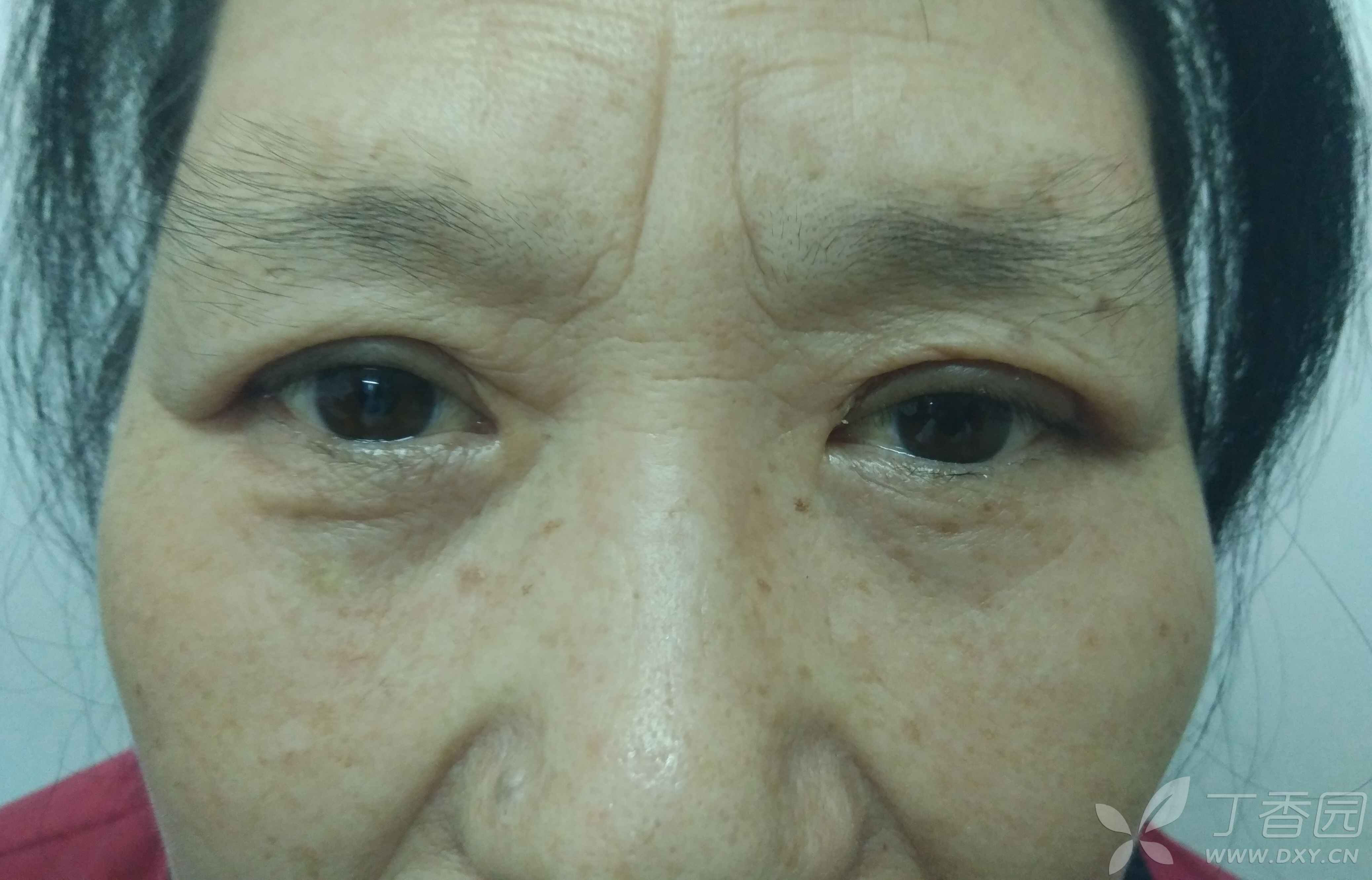 眼睑闭合不全