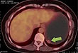 隐形杀手——胃肠间质瘤 (GIST) 探秘