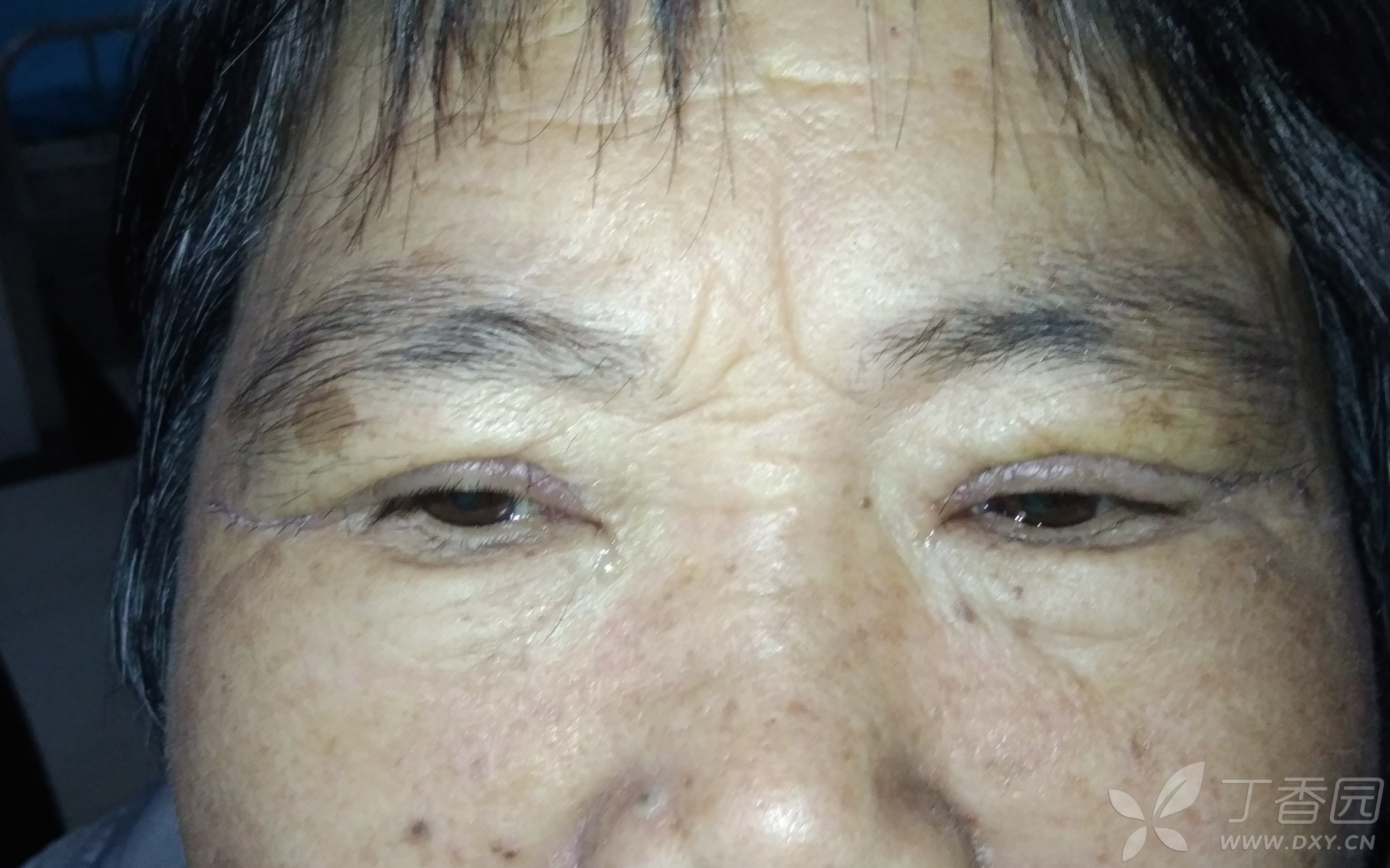 【讨论】上睑皮肤松弛的改进方法 [病例帖]