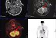 PET/MR 在偶发瘤检出中的应用价值 1