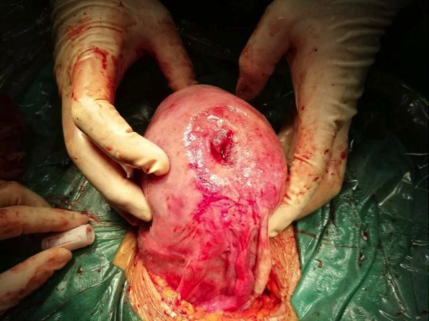卵巢囊肿肚子大的图片图片