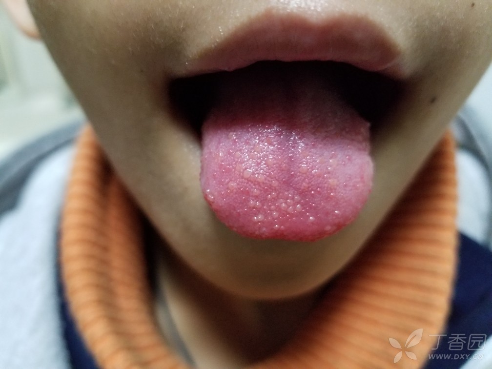 宝宝舌头草莓舌图片图片