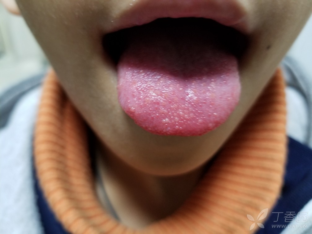 门诊遇一患儿草莓舌?