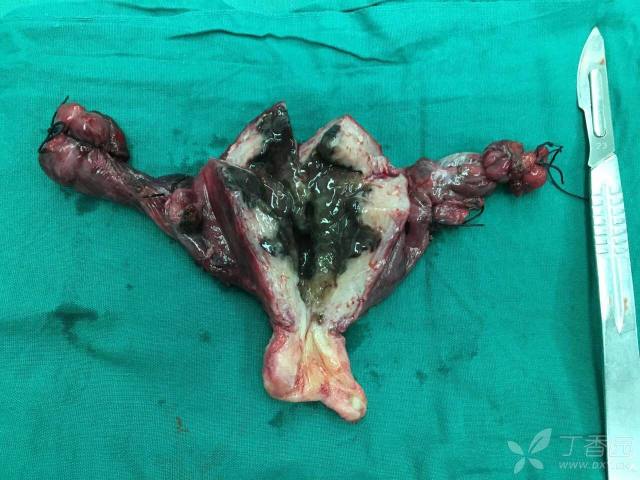 这是史上切口最敞亮的子宫切除术切下的子宫——从剑突下到耻骨上
