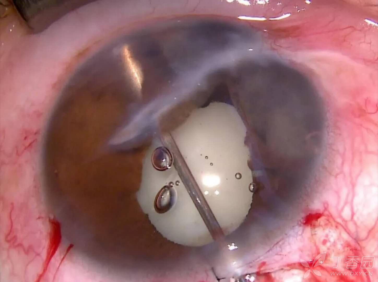 左眼角膜中央斜行穿通伤瘢痕,下方前房内约2/5虹膜囊肿