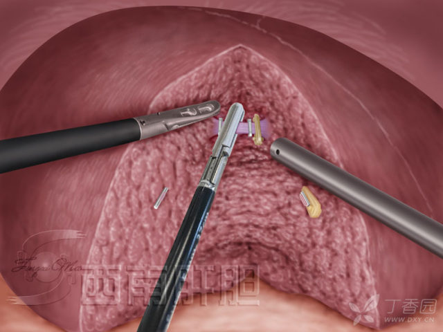 17. 可吸收夹 连发钛夹 ligasure1637:离断s8段中肝静脉分支