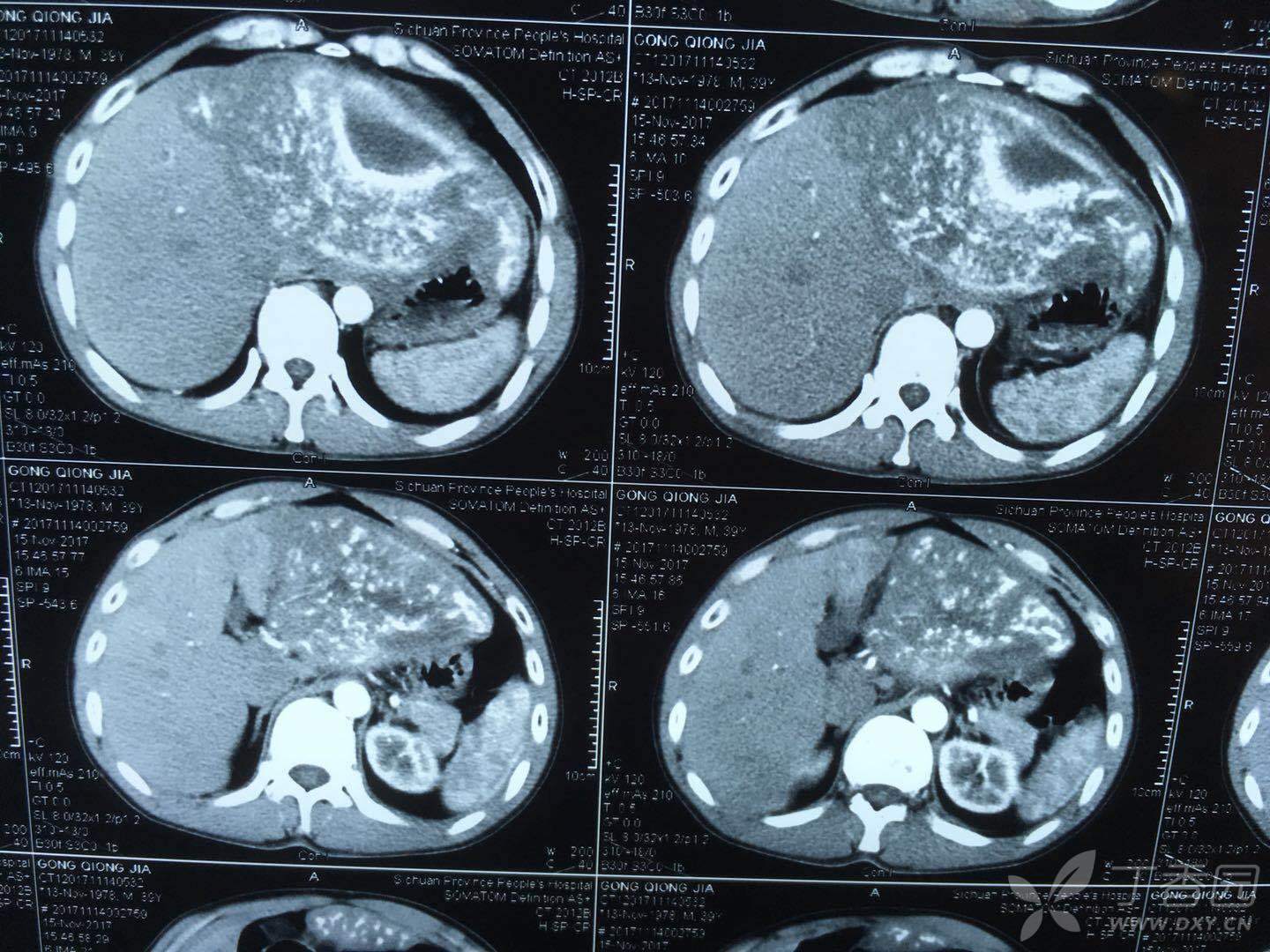左肝巨大包虫一例 - 普通外科讨论版 -丁香园论坛