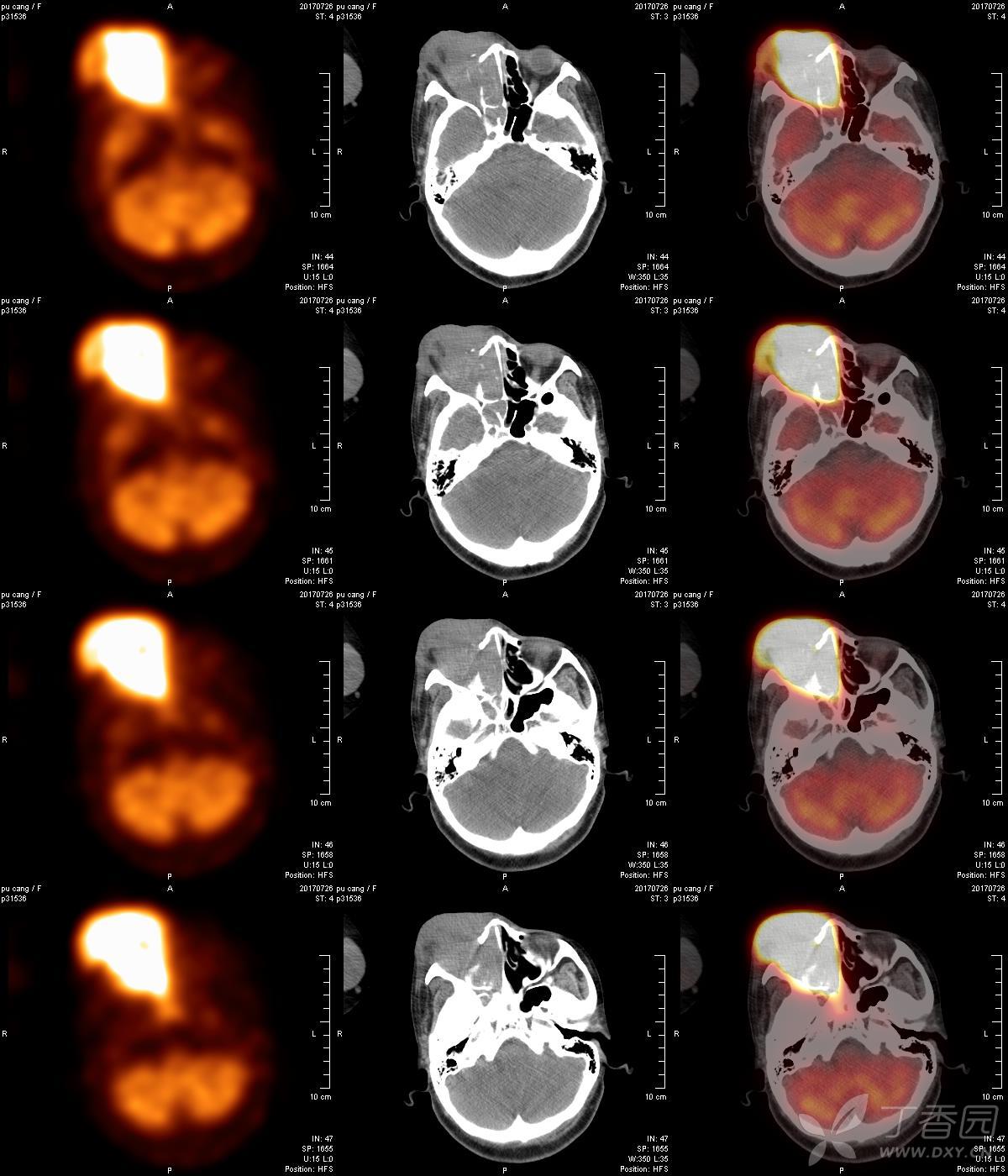 pet-ct:肺病变性质? - 影像医学和核医学讨论版 -丁香园论坛