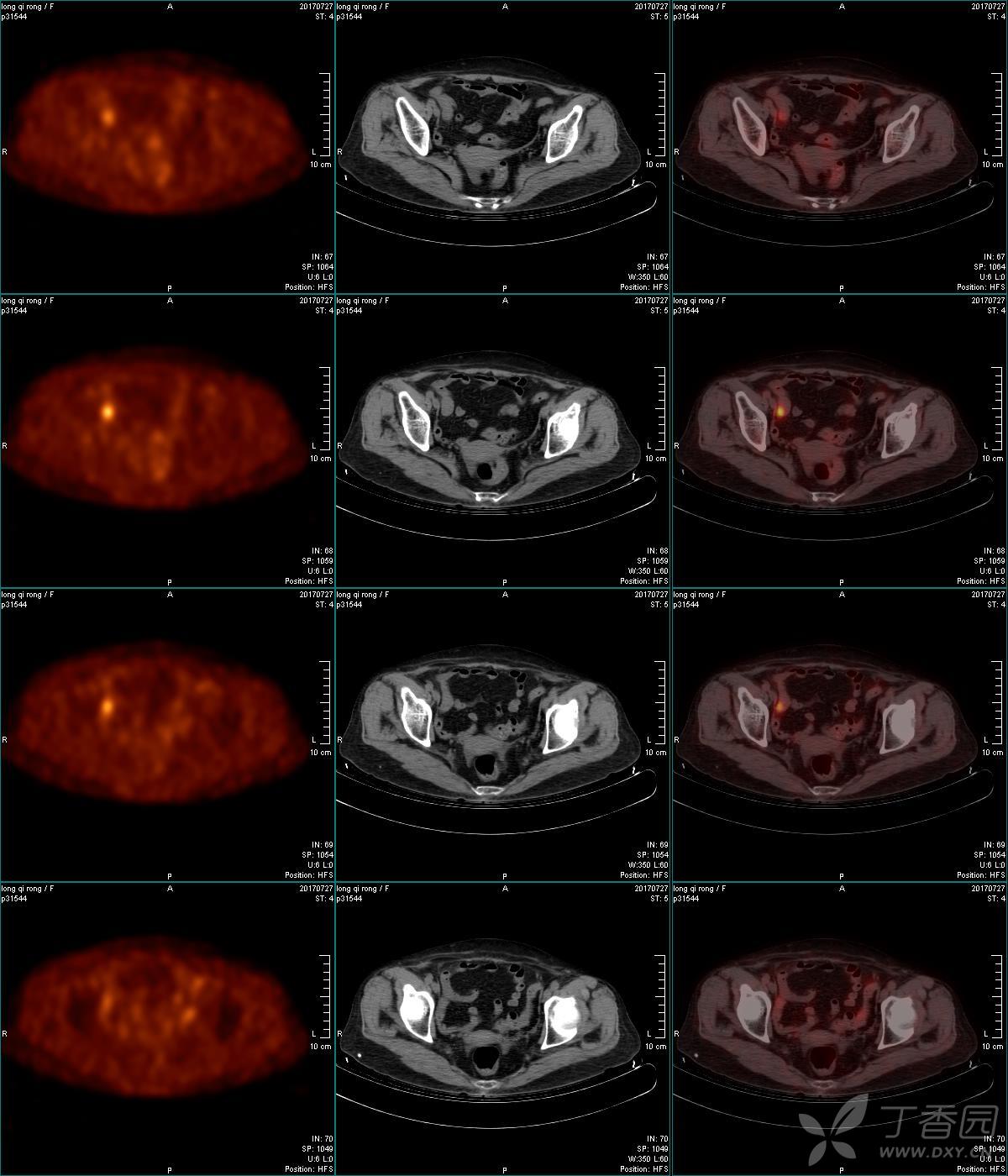 pet-ct:雙側腎上腺病變,性質? [病例帖]