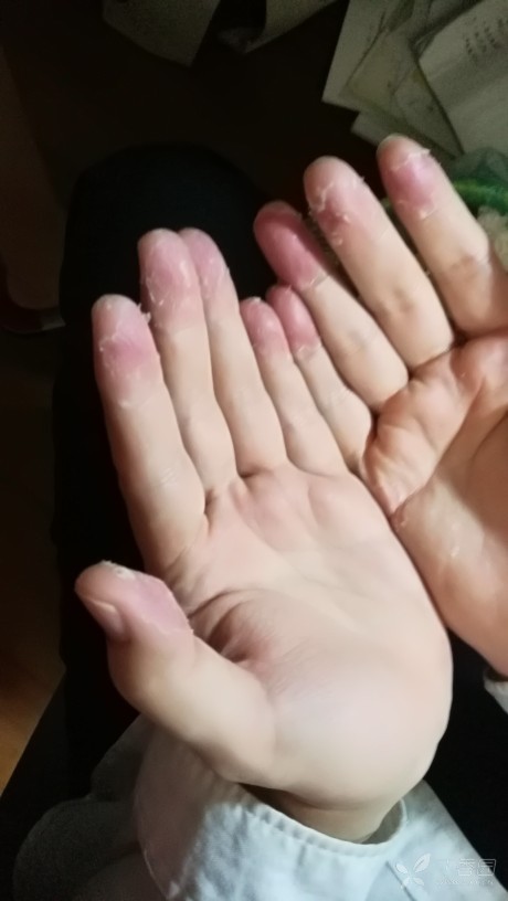 求助各位老师,疑似手部表皮松懈症 - 皮肤与性传播疾病讨论版 -丁香园