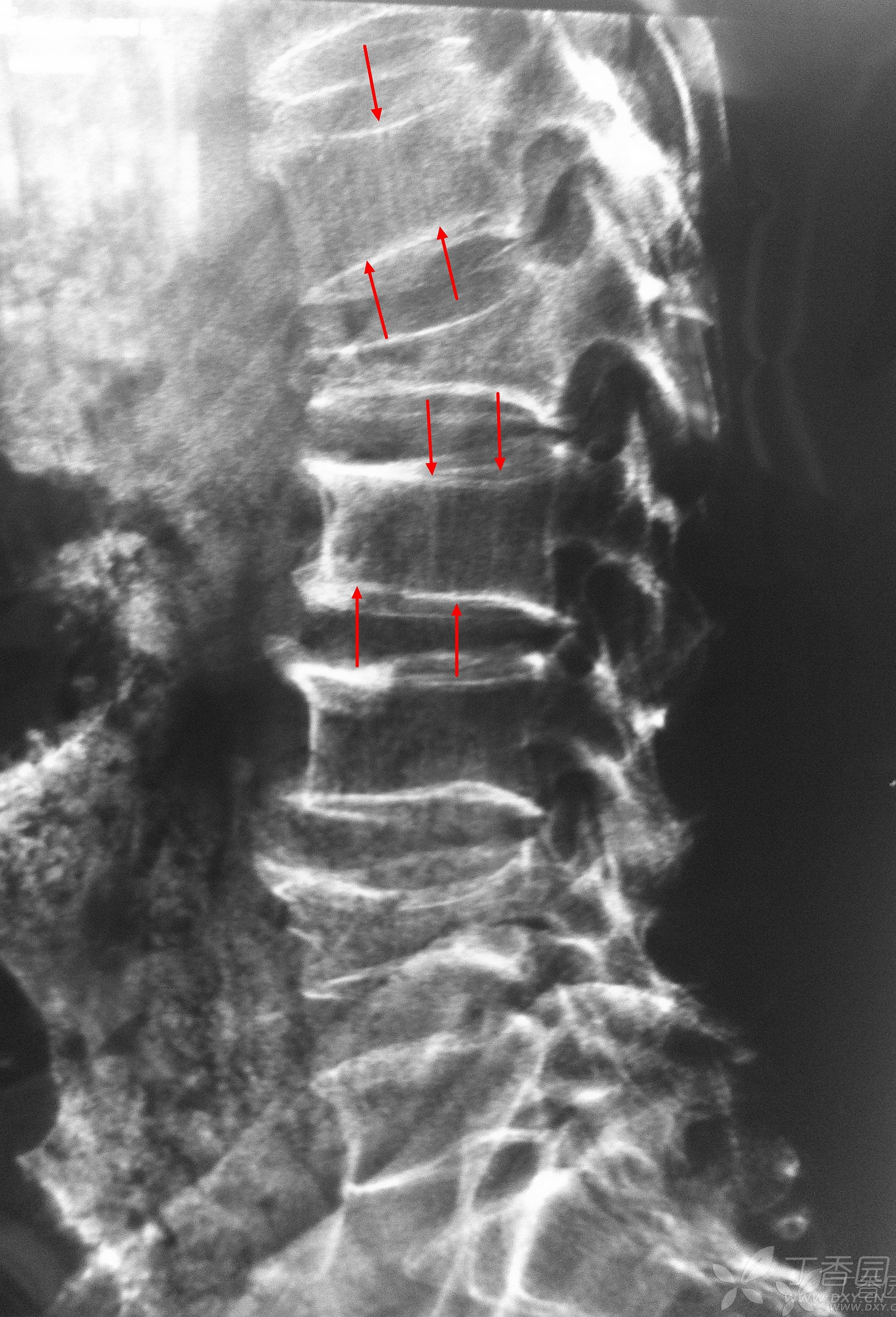 t11椎体骨图片图片