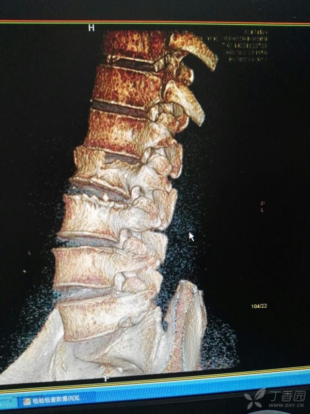 l2压缩性骨折求助 [病例帖]
