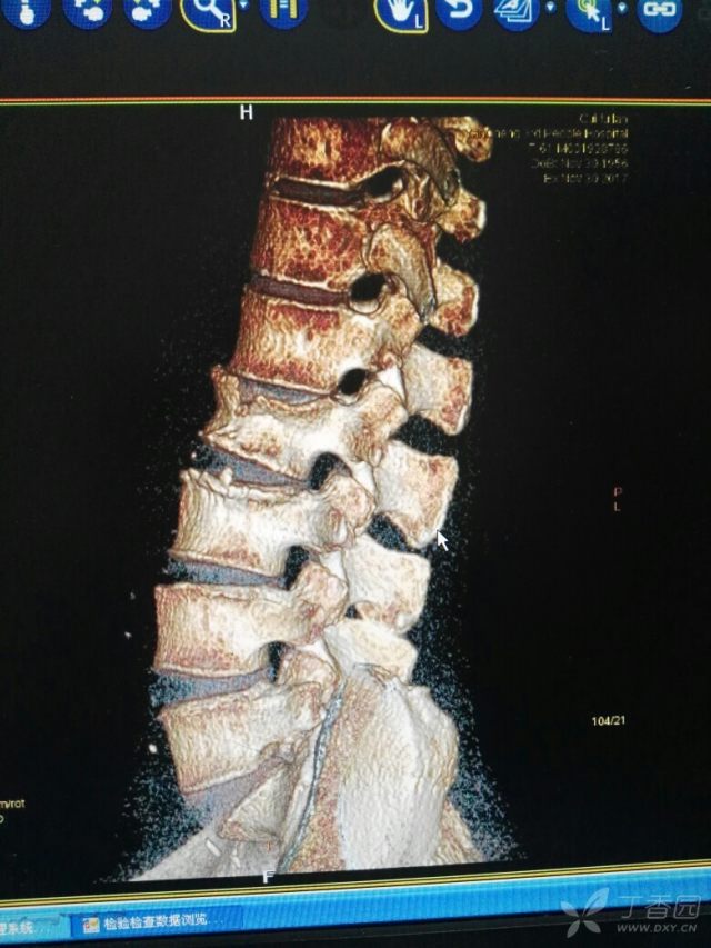 l2椎体骨折位置图图片