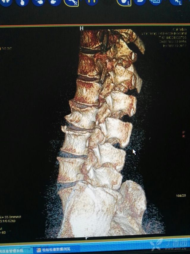 l2压缩性骨折求助 [病例帖]
