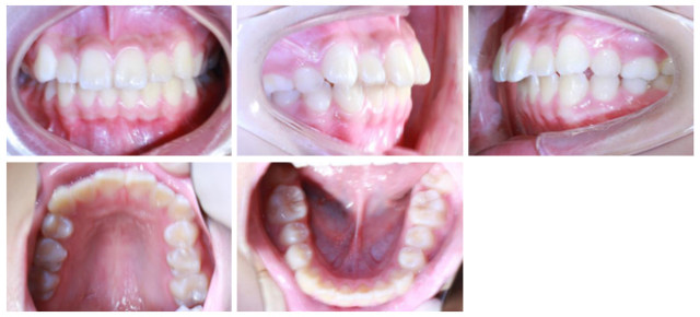 正畸病例 正畸系列病例（三）：做好正畸医治「后勤工作」，杰出口腔卫生稳固牙周健康