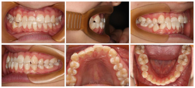 龈下刮治懊悔死 正畸系列病例（二）：伴牙周疾病患者正畸医治，口腔护理宣教保护牙周健康