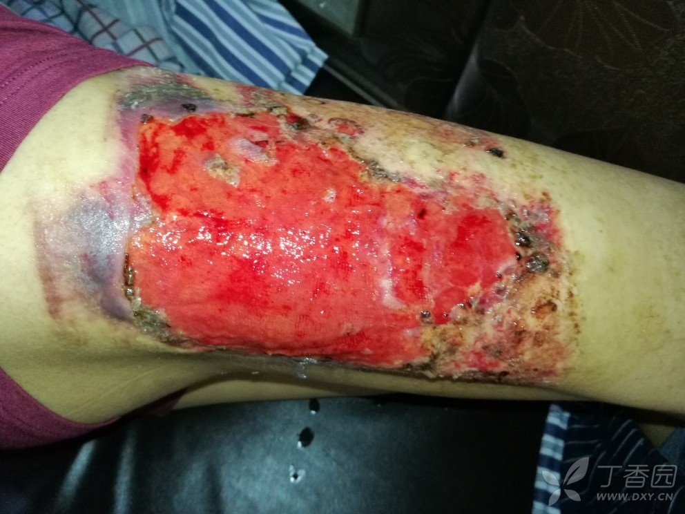 求助,取皮刀取皮后,供区长时间不愈合,求治疗方案,谢谢大师们 [病例帖