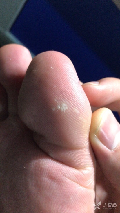 这是跖疣复发对吗?冷冻治疗后
