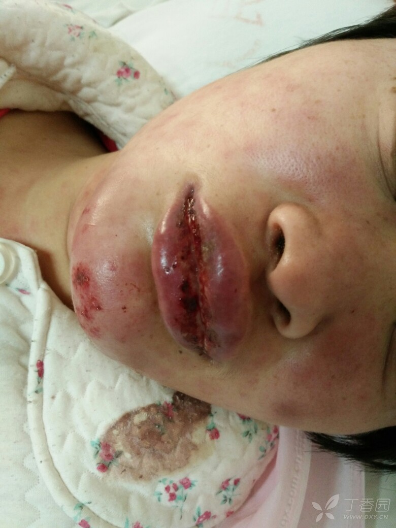 发热1周,伴口唇水肿,纳差 [病例帖]