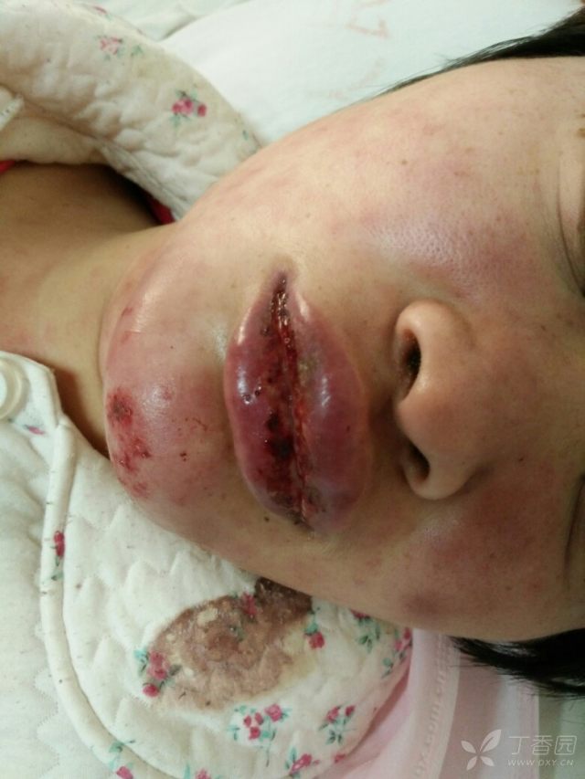 患者周某,27岁,女性,未婚,主因"间断发热伴口唇水肿,纳差"入院