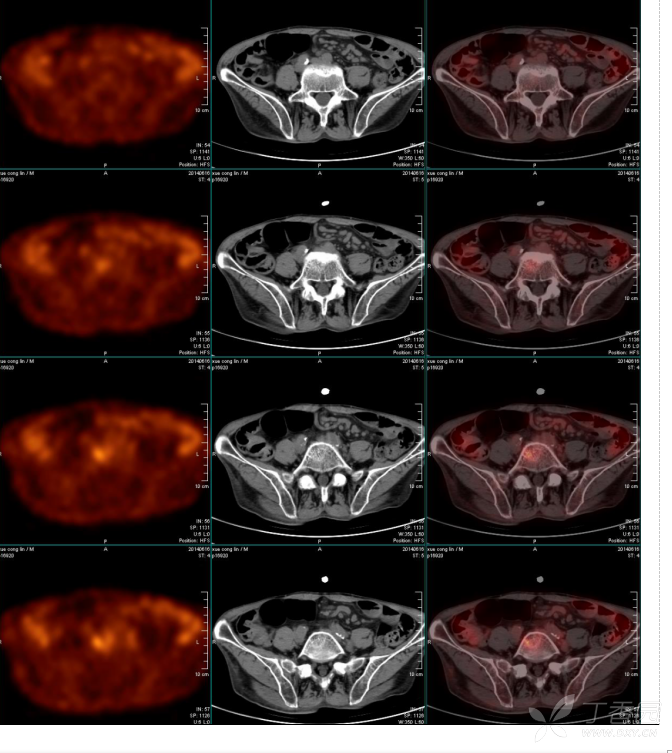 pet-ct:淋巴瘤? - 影像医学和核医学讨论版 -丁香园论坛