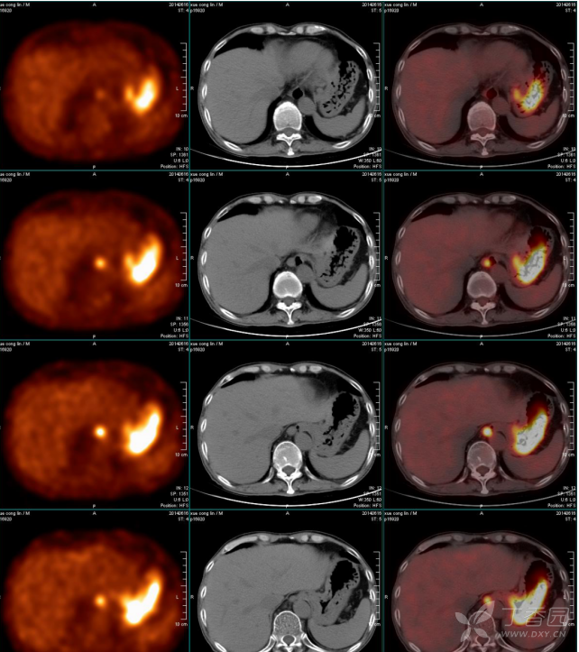 pet-ct:淋巴瘤? - 影像医学和核医学讨论版 -丁香园论坛