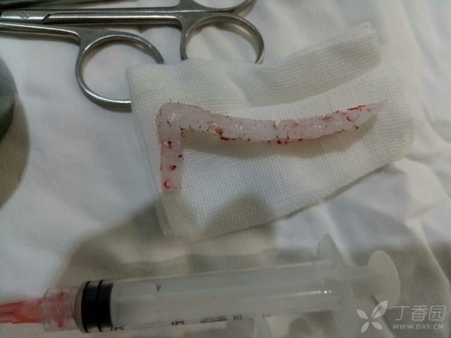 【讨论】硅胶隆鼻术后鼻尖皮肤破溃假体取出一例~~ - 丁香园论坛