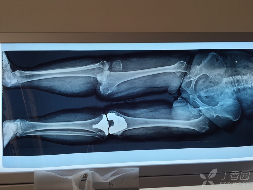 没有疼痛,没有外伤.怎么导致的呢 [病例帖]