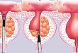 JUA 指南：男性下尿路症状和良性前列腺增生（下）