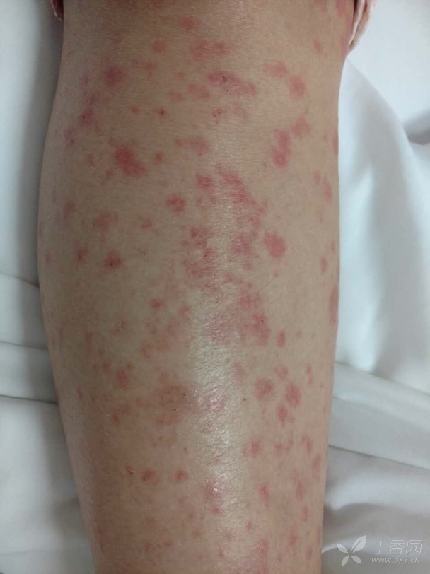 玫瑰糠疹和梅毒的图片图片