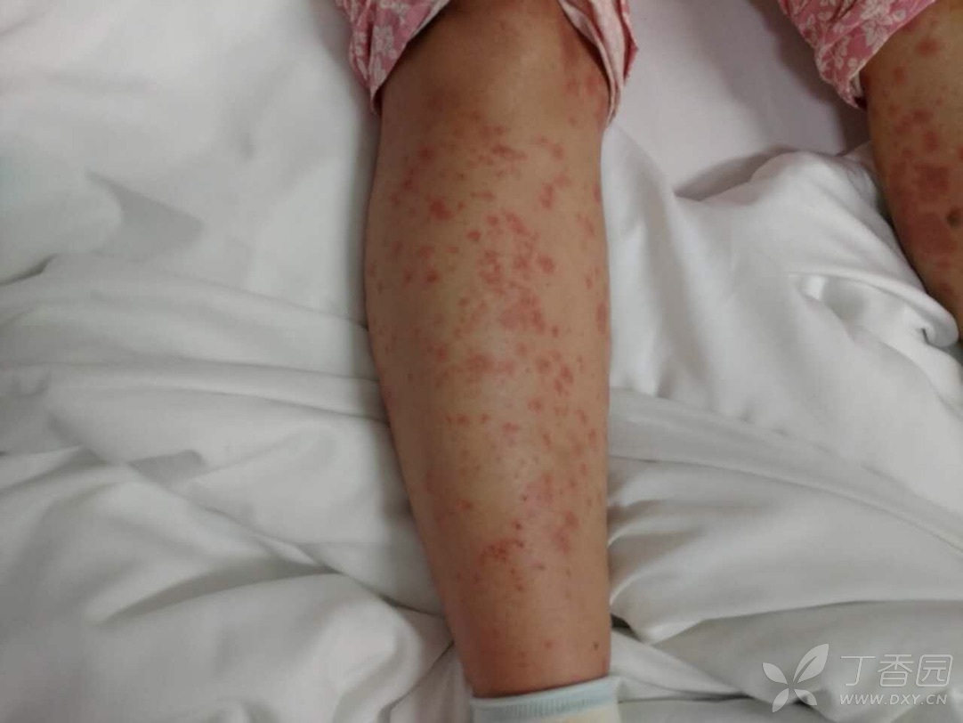 三期梅毒皮肤图片