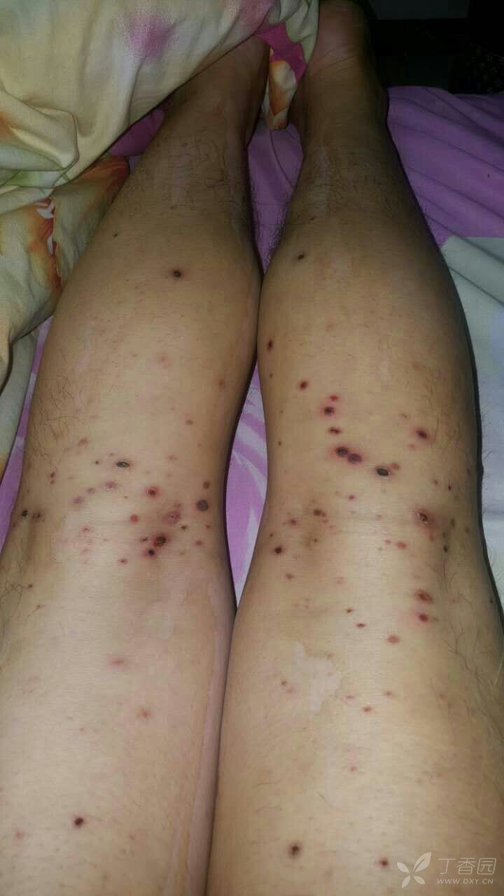 胸,四肢相继出现红疹,前去当地医院诊断为湿疹,另一家医院诊断为水痘