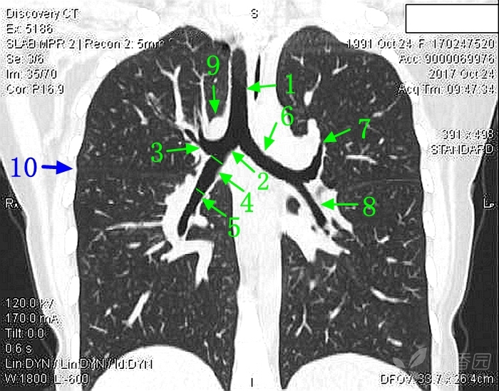 ct肺门位置图片
