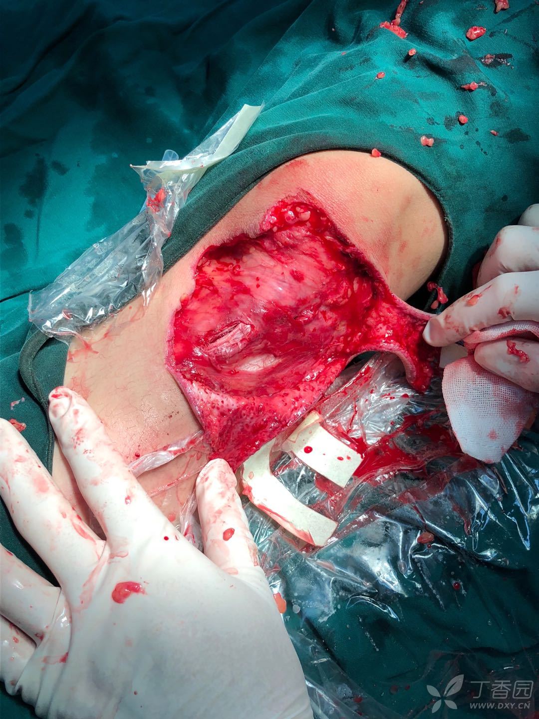 治疗经过:急诊行清创原位皮瓣植皮,术后伤口出现部分皮瓣坏死感染,予