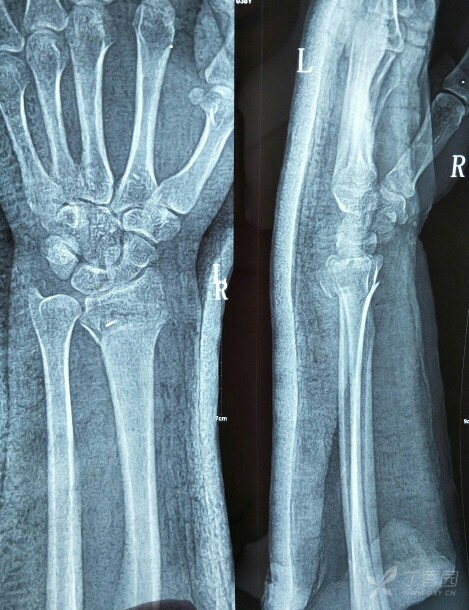 患者女,38岁,外伤后右克雷氏骨折三天.