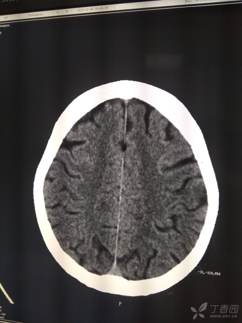 大脑镰低密度影,ct值约-4?