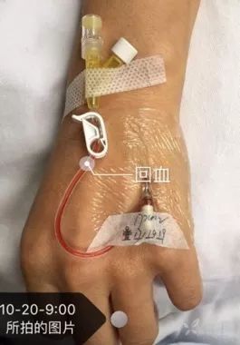 图 1:夹闭在留置针的中间段(延长管中 1/3 段)(备注:输液结束未 u