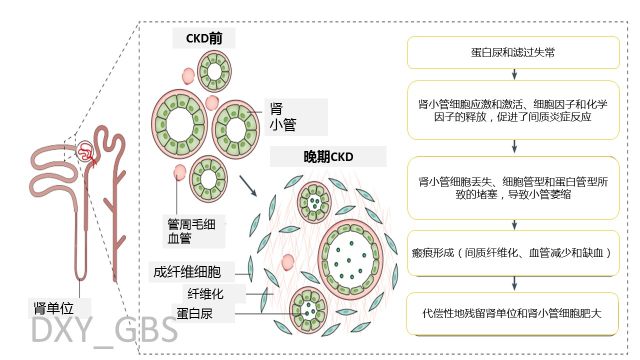 慢性肾衰竭发病机制图片