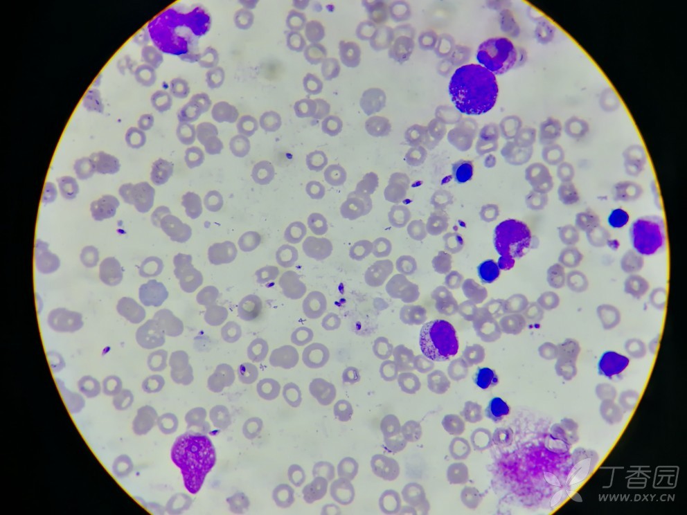 利什曼感染见到的噬血细胞
