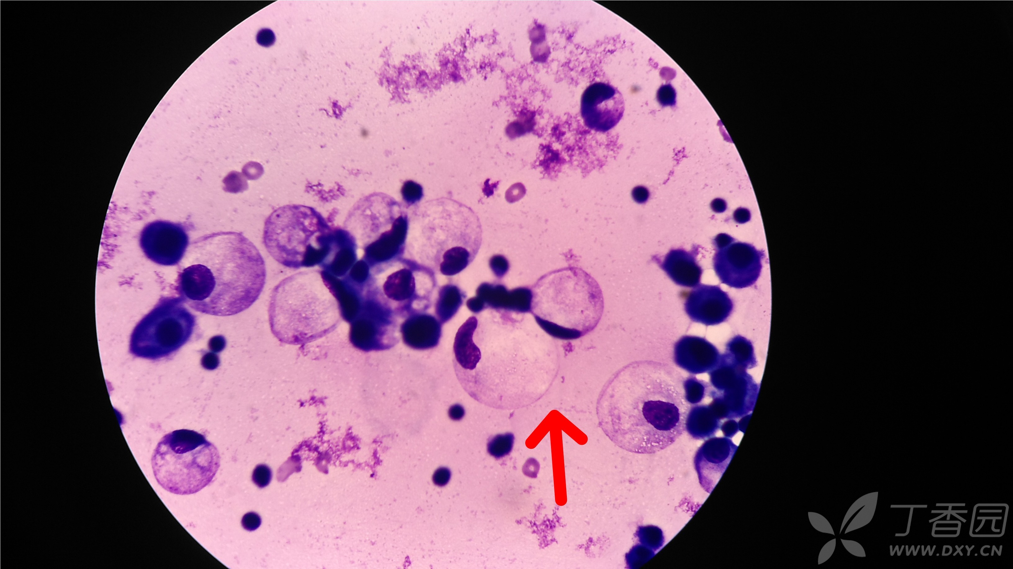 这些是什么细胞(胸水瑞吉氏染色)哪位大咖指点下