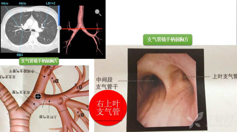 双腔气管导管图解图片