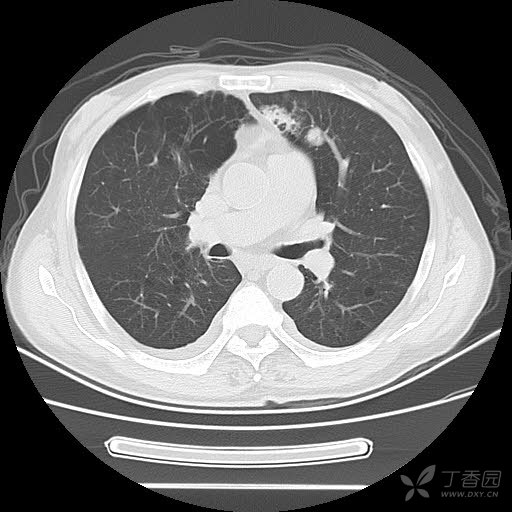 左肺上叶舌段结节影(ct值34hu),结节内侧可见不规则肿块(ct值25hu)