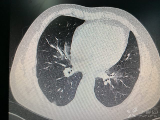 两肺阴影,间质性肺炎? [病例帖]