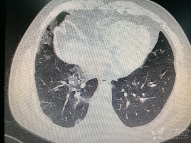 两肺阴影,间质性肺炎? [病例帖]