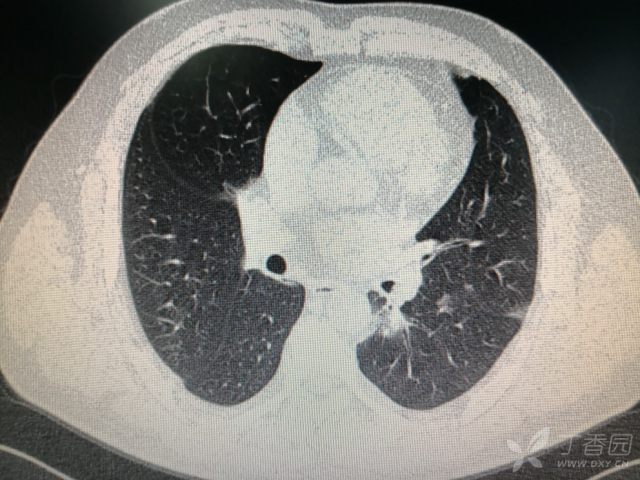两肺阴影,间质性肺炎? [病例帖]