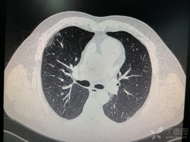 两肺阴影,间质性肺炎? [病例帖]