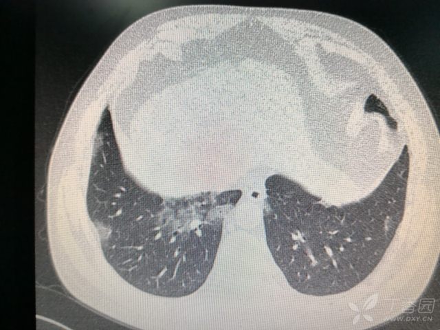 两肺阴影,间质性肺炎? [病例帖]