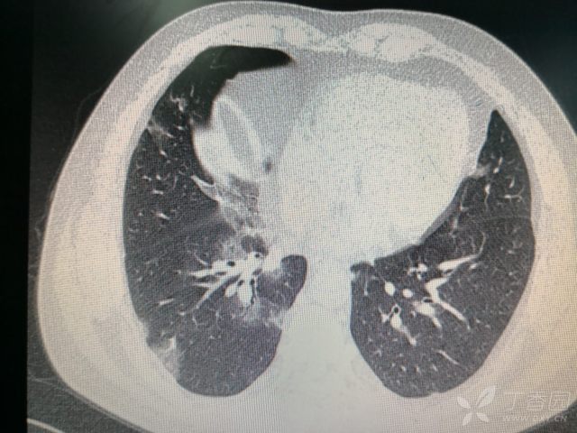 两肺阴影,间质性肺炎? [病例帖]
