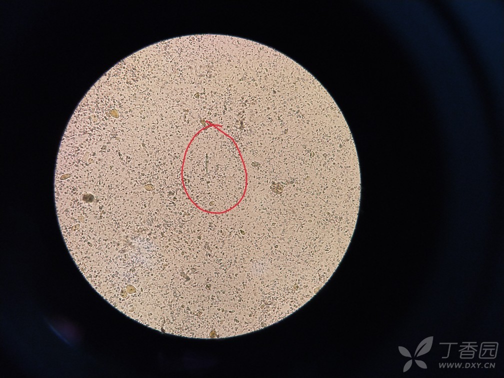 求助是不是夏科雷登结晶