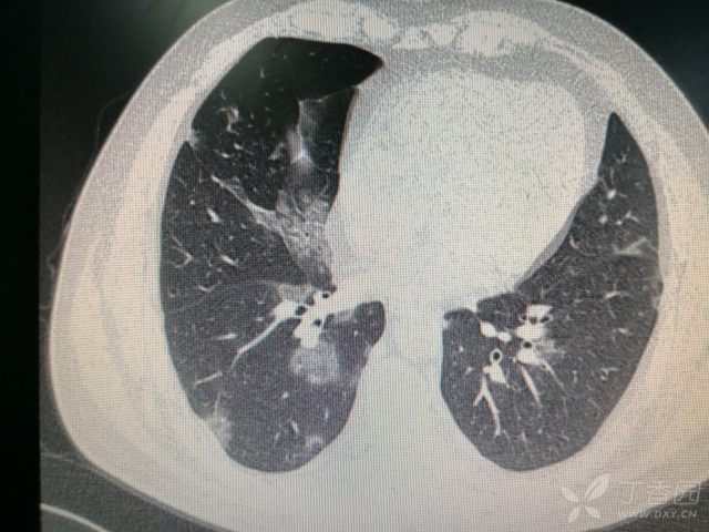 两肺阴影,间质性肺炎? [病例帖]